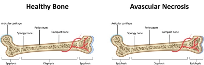 Avascular Necrosis Illustration. Image Credit: Joshya / Shutterstock